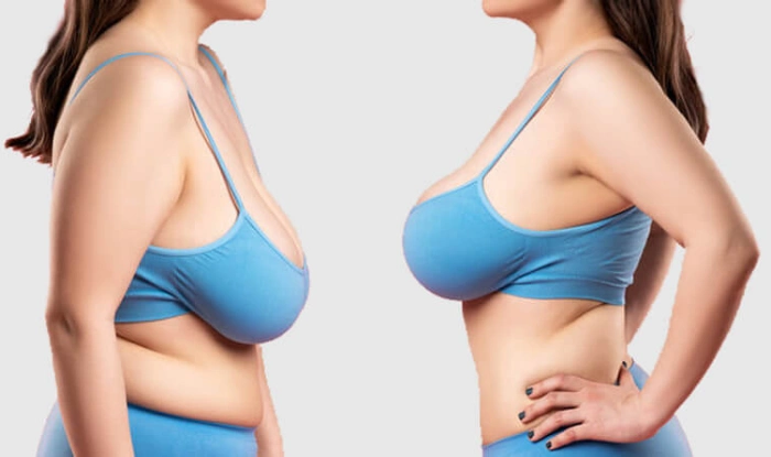 Cosmetic Procedures for Breast Size